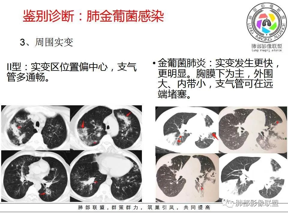 【PPT】侵袭性肺曲霉病影像分型及表现 【PPT】侵袭性肺曲霉病影像分型及表现