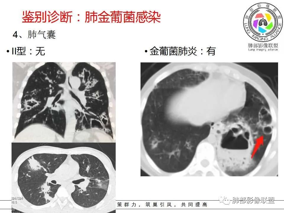 【PPT】侵袭性肺曲霉病影像分型及表现 【PPT】侵袭性肺曲霉病影像分型及表现