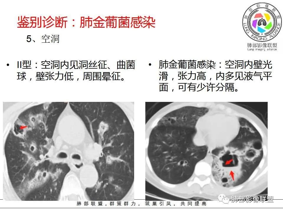 【PPT】侵袭性肺曲霉病影像分型及表现 【PPT】侵袭性肺曲霉病影像分型及表现