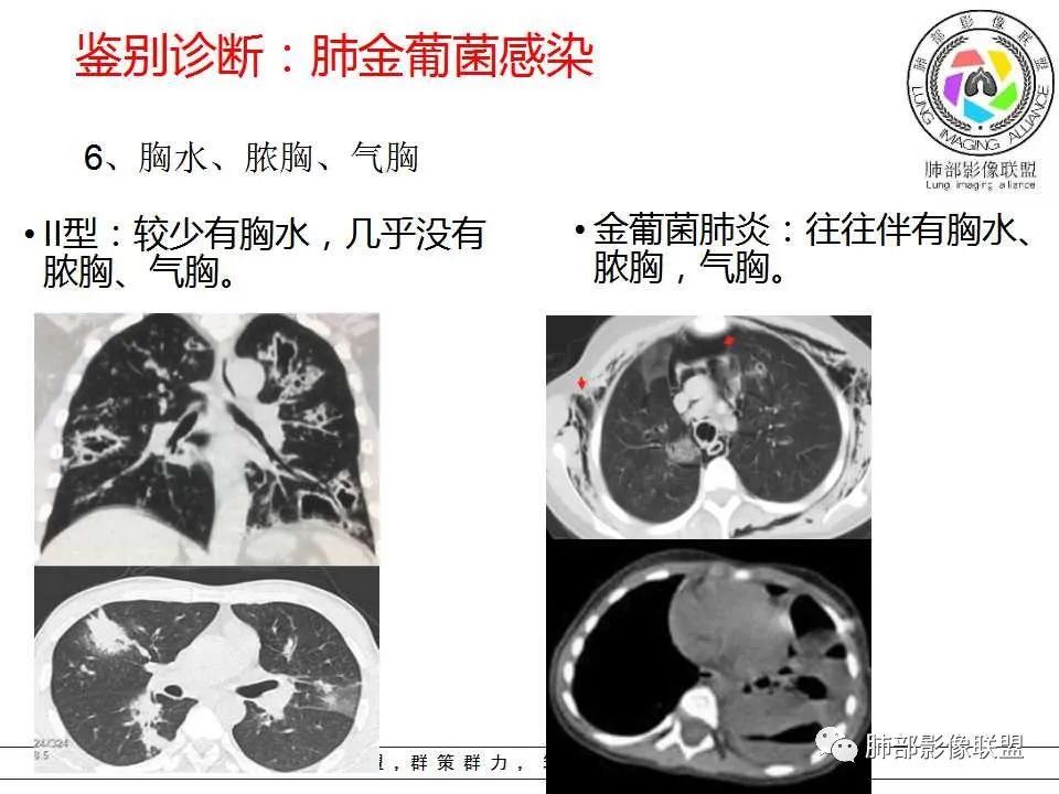 【PPT】侵袭性肺曲霉病影像分型及表现 【PPT】侵袭性肺曲霉病影像分型及表现