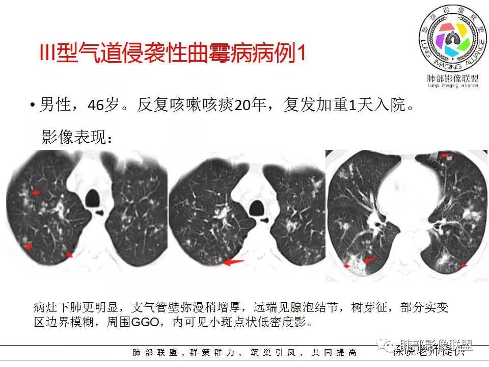 【PPT】侵袭性肺曲霉病影像分型及表现 【PPT】侵袭性肺曲霉病影像分型及表现