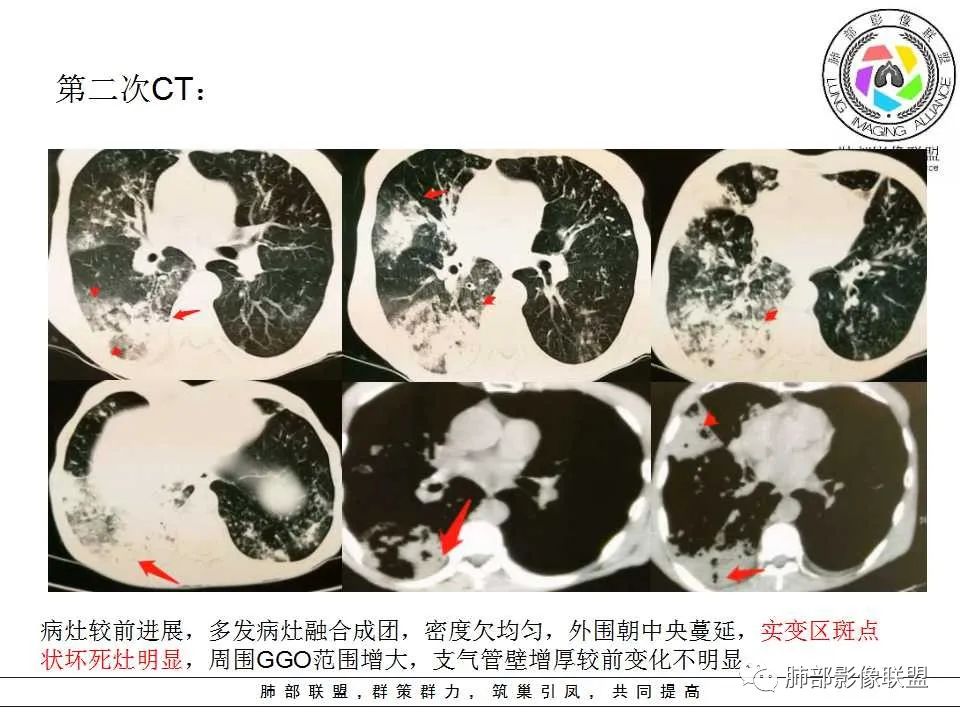 【PPT】侵袭性肺曲霉病影像分型及表现 【PPT】侵袭性肺曲霉病影像分型及表现