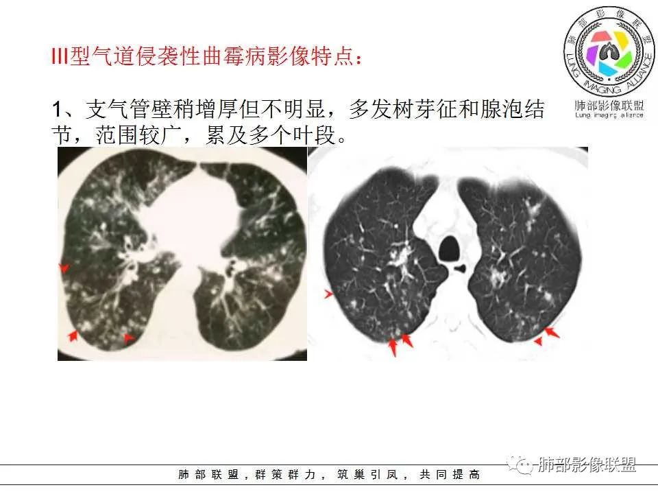 【PPT】侵袭性肺曲霉病影像分型及表现 【PPT】侵袭性肺曲霉病影像分型及表现