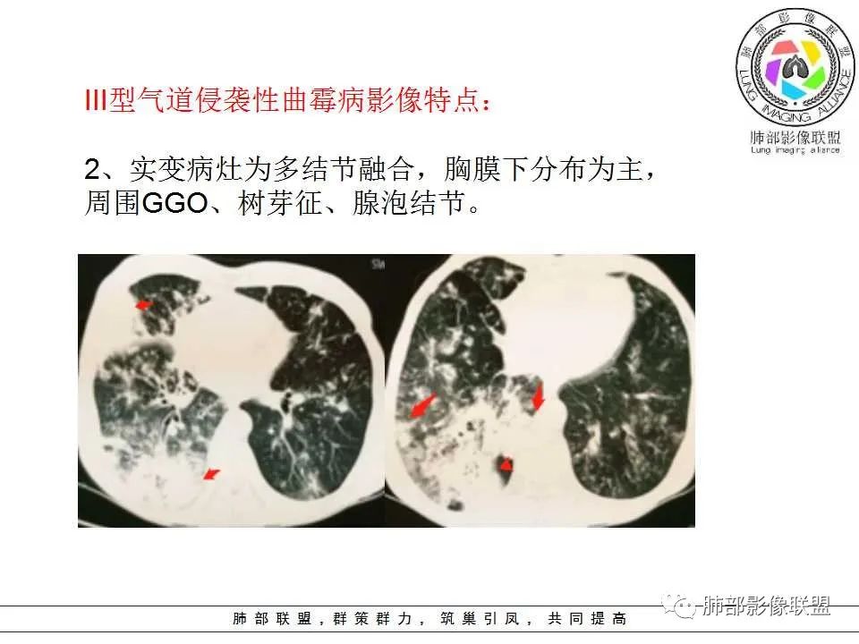 【PPT】侵袭性肺曲霉病影像分型及表现 【PPT】侵袭性肺曲霉病影像分型及表现