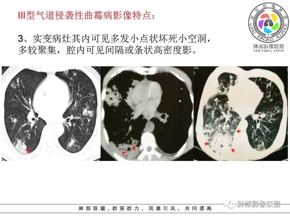 【PPT】侵袭性肺曲霉病影像分型及表现 【PPT】侵袭性肺曲霉病影像分型及表现