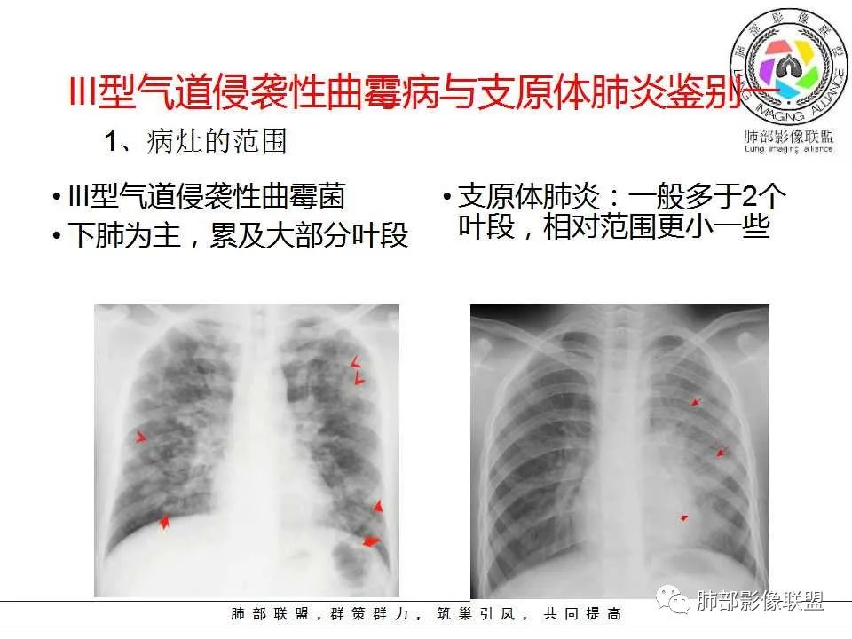【PPT】侵袭性肺曲霉病影像分型及表现 【PPT】侵袭性肺曲霉病影像分型及表现