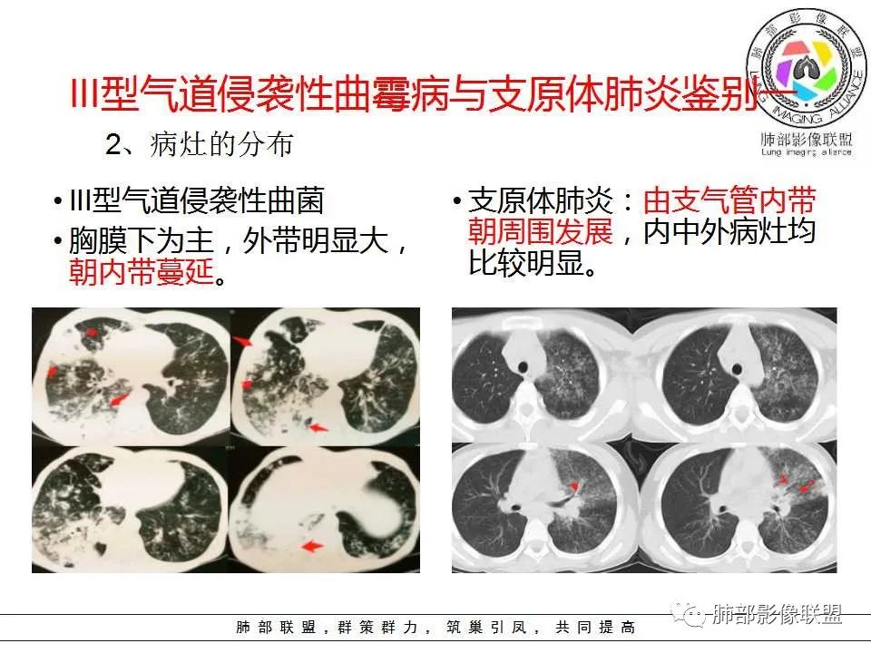 【PPT】侵袭性肺曲霉病影像分型及表现 【PPT】侵袭性肺曲霉病影像分型及表现