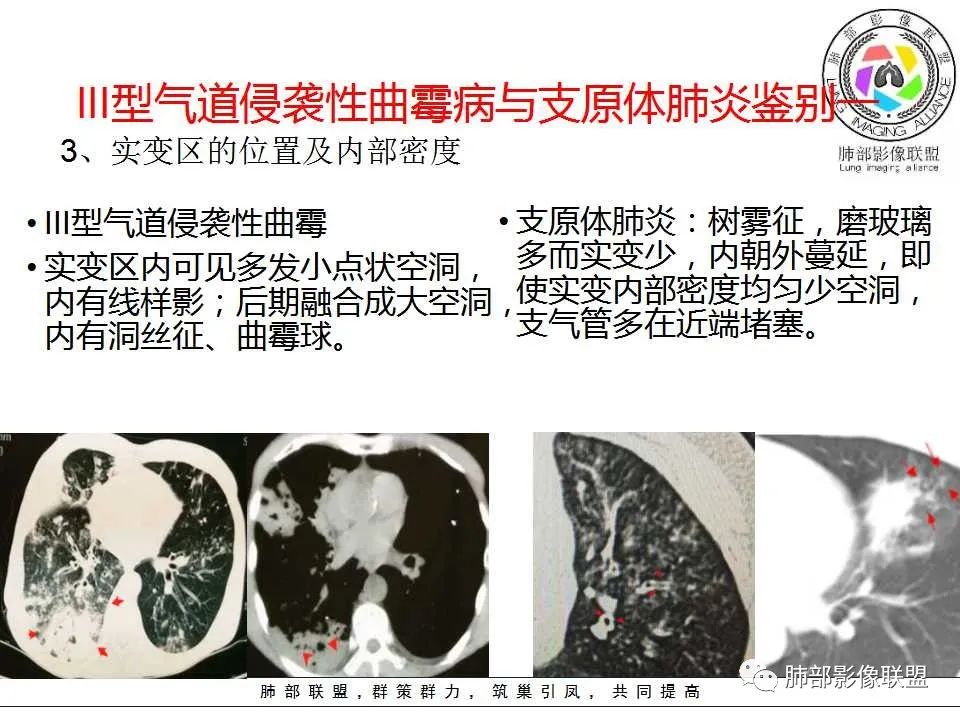 【PPT】侵袭性肺曲霉病影像分型及表现 【PPT】侵袭性肺曲霉病影像分型及表现