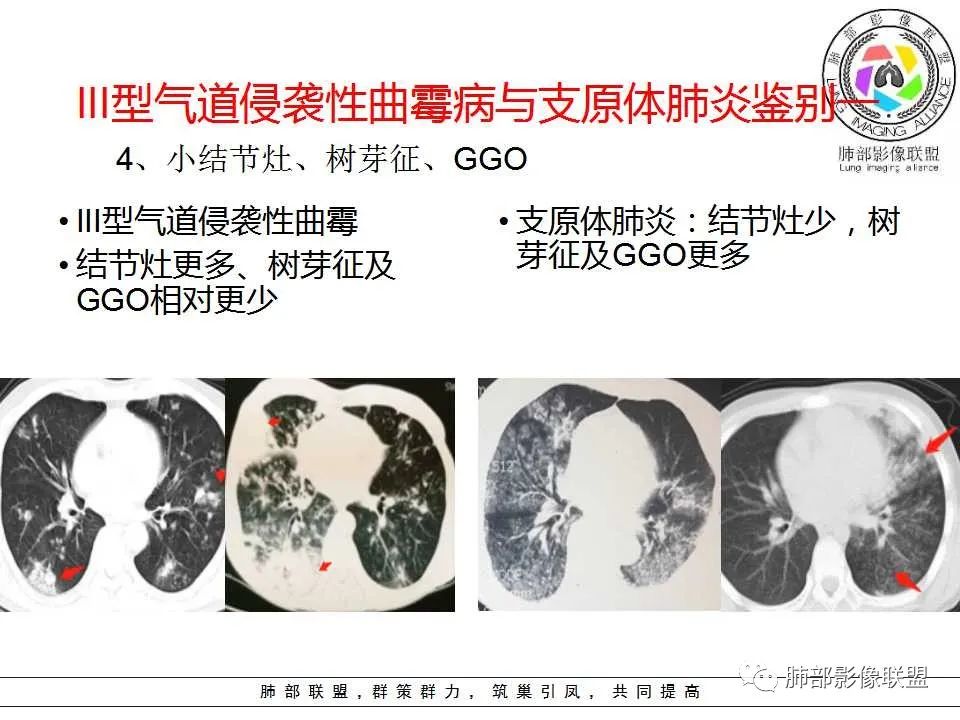 【PPT】侵袭性肺曲霉病影像分型及表现 【PPT】侵袭性肺曲霉病影像分型及表现