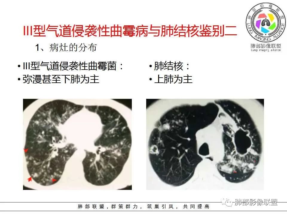 【PPT】侵袭性肺曲霉病影像分型及表现 【PPT】侵袭性肺曲霉病影像分型及表现