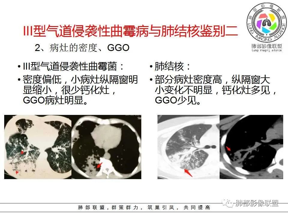 【PPT】侵袭性肺曲霉病影像分型及表现 【PPT】侵袭性肺曲霉病影像分型及表现