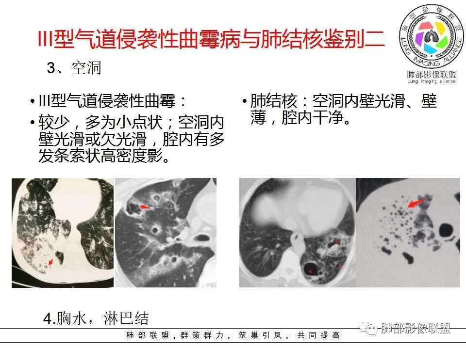 【PPT】侵袭性肺曲霉病影像分型及表现 【PPT】侵袭性肺曲霉病影像分型及表现