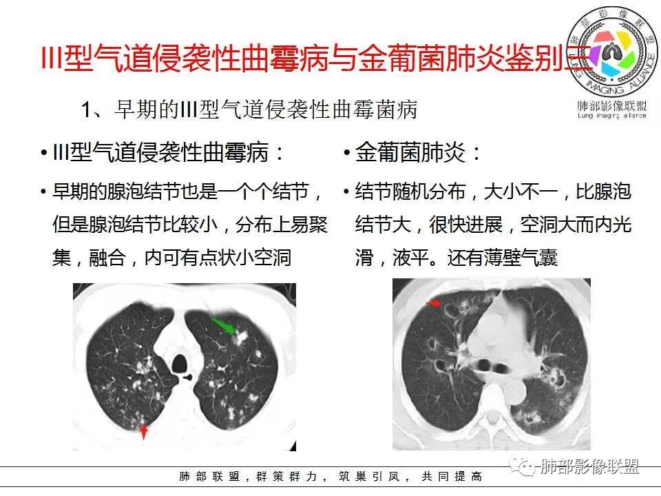 【PPT】侵袭性肺曲霉病影像分型及表现 【PPT】侵袭性肺曲霉病影像分型及表现