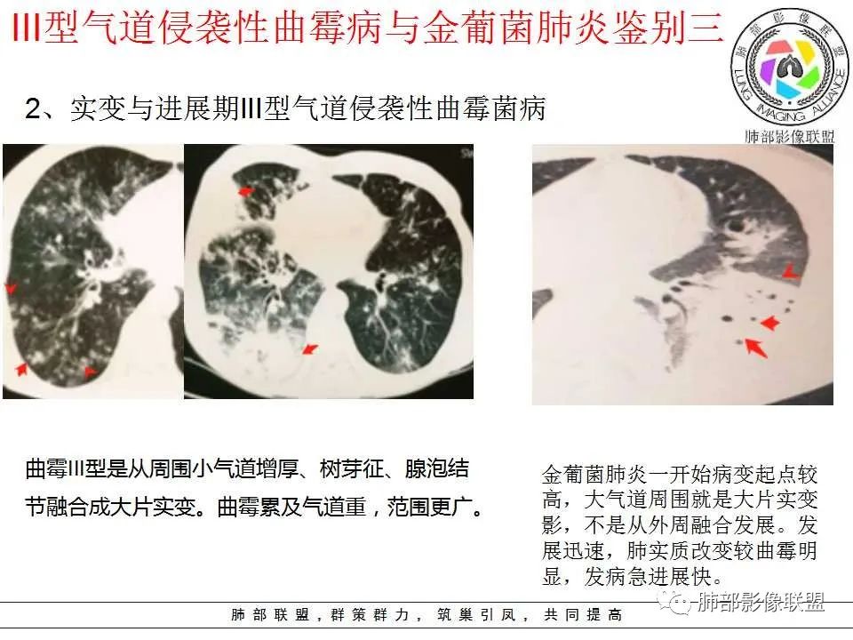 【PPT】侵袭性肺曲霉病影像分型及表现 【PPT】侵袭性肺曲霉病影像分型及表现