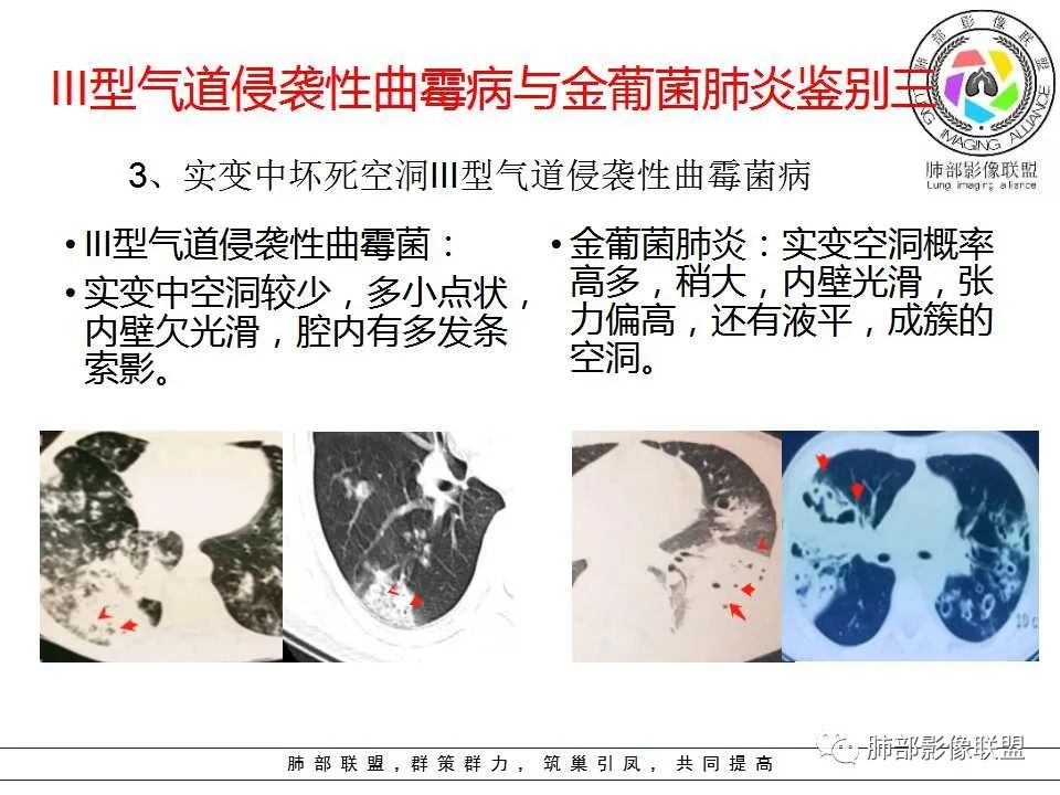【PPT】侵袭性肺曲霉病影像分型及表现 【PPT】侵袭性肺曲霉病影像分型及表现