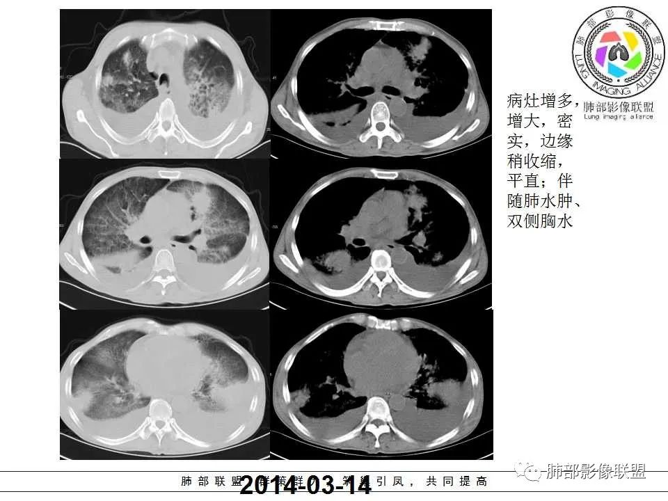 【PPT】侵袭性肺曲霉病影像分型及表现 【PPT】侵袭性肺曲霉病影像分型及表现