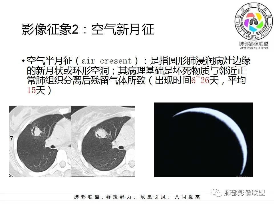 【PPT】侵袭性肺曲霉病影像分型及表现 【PPT】侵袭性肺曲霉病影像分型及表现