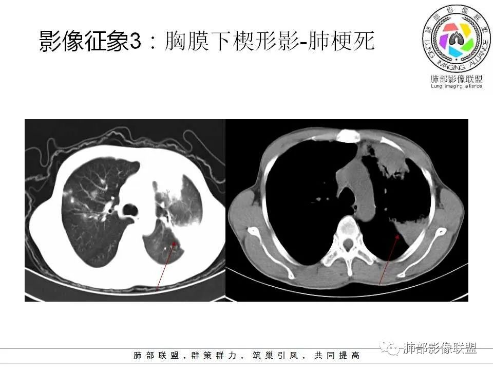【PPT】侵袭性肺曲霉病影像分型及表现 【PPT】侵袭性肺曲霉病影像分型及表现