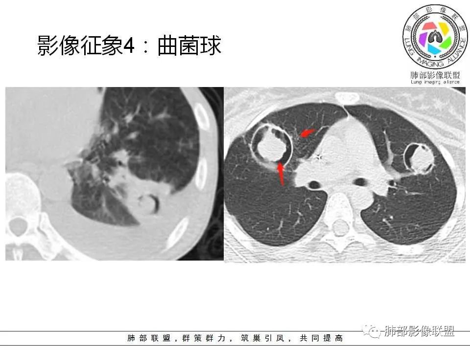 【PPT】侵袭性肺曲霉病影像分型及表现 【PPT】侵袭性肺曲霉病影像分型及表现
