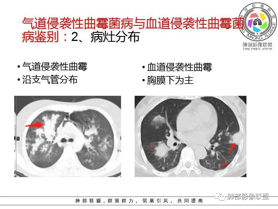 【PPT】侵袭性肺曲霉病影像分型及表现 【PPT】侵袭性肺曲霉病影像分型及表现