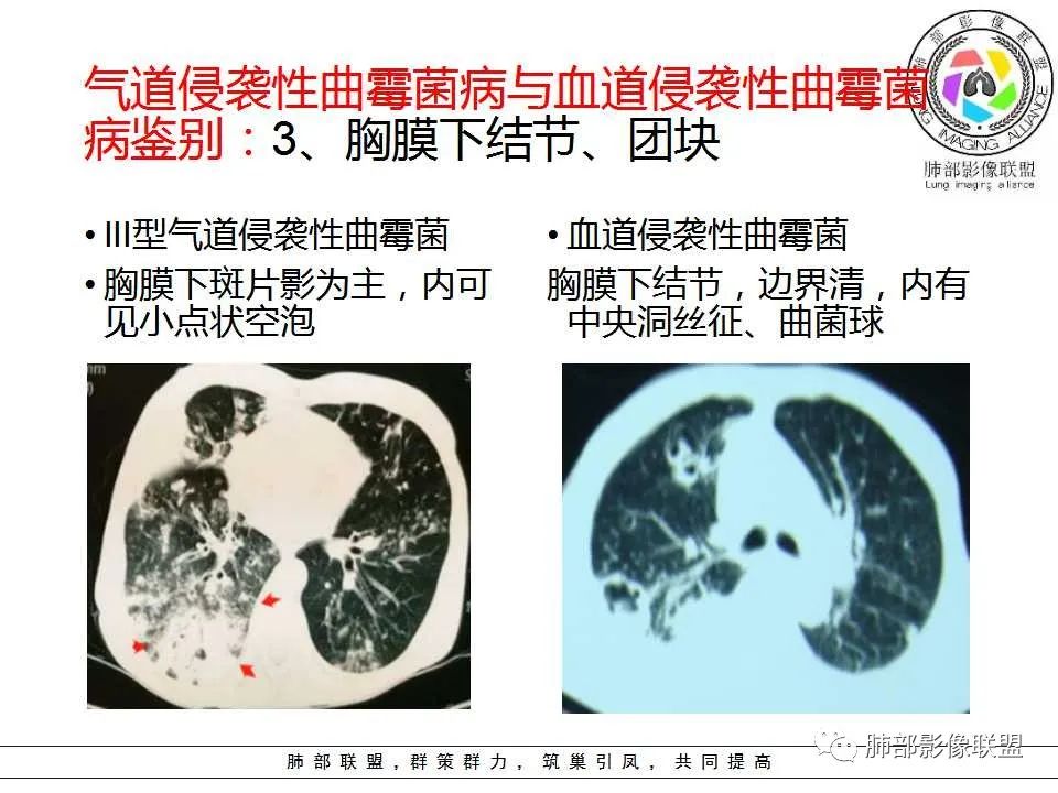 【PPT】侵袭性肺曲霉病影像分型及表现 【PPT】侵袭性肺曲霉病影像分型及表现