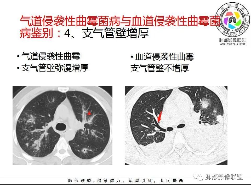 【PPT】侵袭性肺曲霉病影像分型及表现 【PPT】侵袭性肺曲霉病影像分型及表现