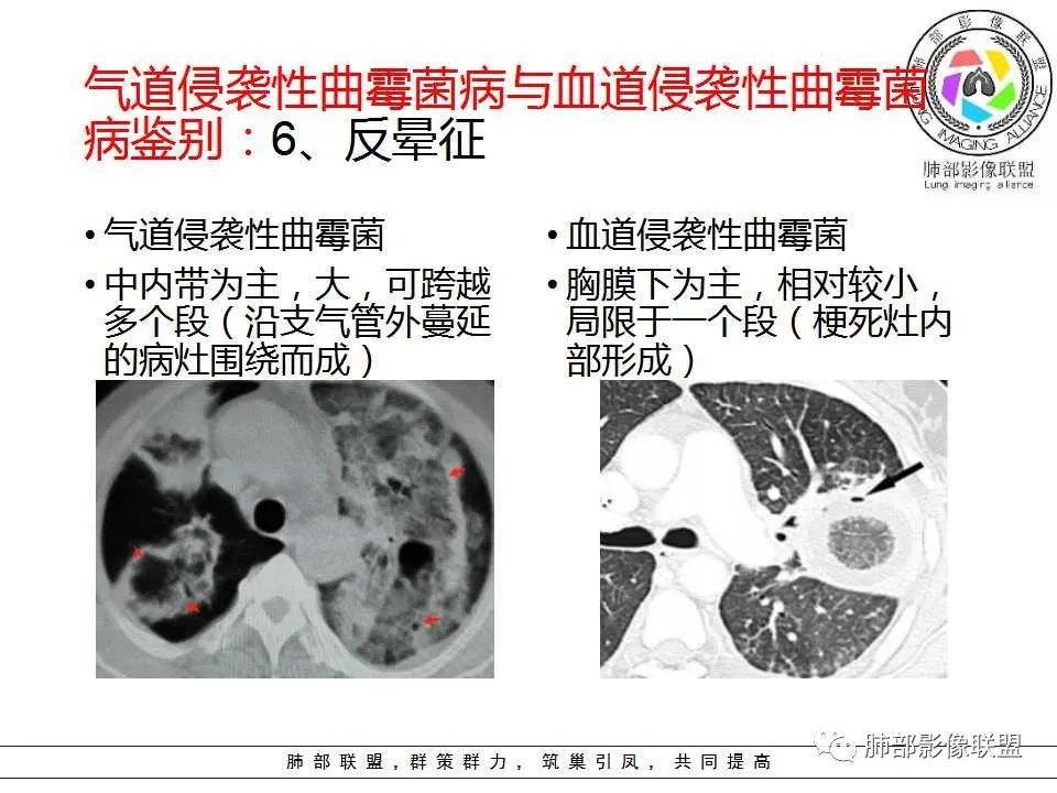 【PPT】侵袭性肺曲霉病影像分型及表现 【PPT】侵袭性肺曲霉病影像分型及表现