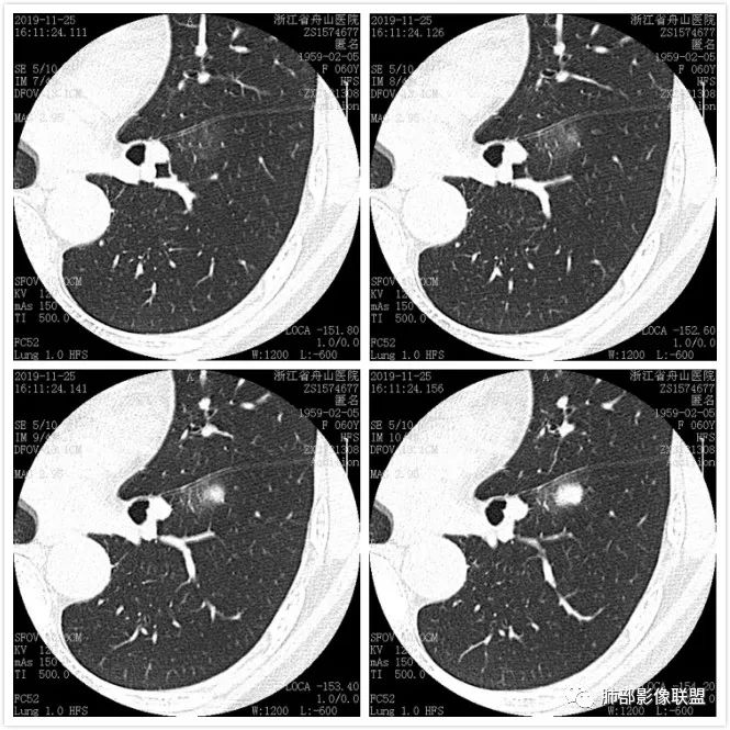 【病例】肺腺癌1例CT影像讨论 【病例】肺腺癌1例CT影像讨论