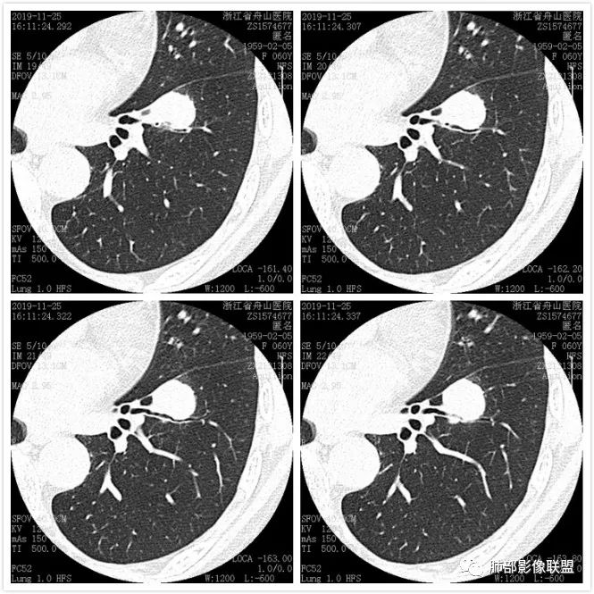【病例】肺腺癌1例CT影像讨论 【病例】肺腺癌1例CT影像讨论