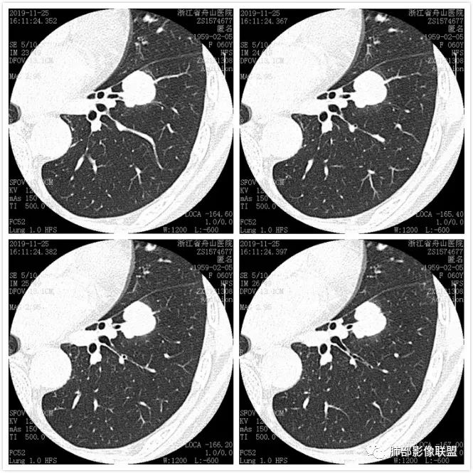 【病例】肺腺癌1例CT影像讨论 【病例】肺腺癌1例CT影像讨论