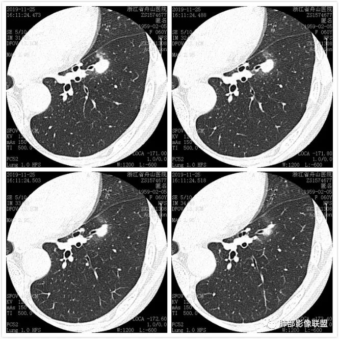 【病例】肺腺癌1例CT影像讨论 【病例】肺腺癌1例CT影像讨论