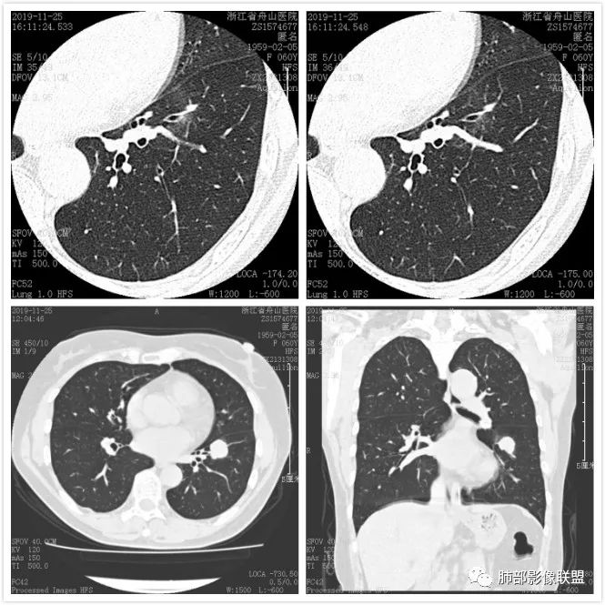 【病例】肺腺癌1例CT影像讨论 【病例】肺腺癌1例CT影像讨论