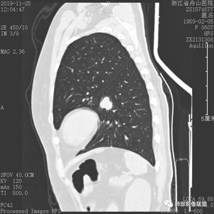 【病例】肺腺癌1例CT影像讨论 【病例】肺腺癌1例CT影像讨论