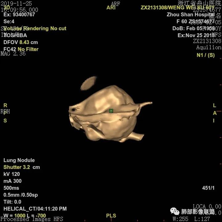 【病例】肺腺癌1例CT影像讨论 【病例】肺腺癌1例CT影像讨论