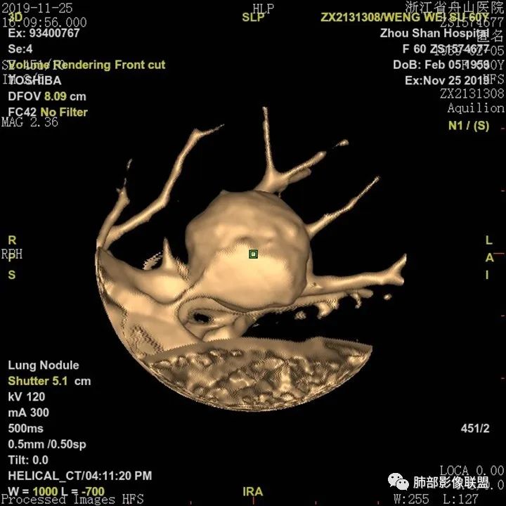 【病例】肺腺癌1例CT影像讨论 【病例】肺腺癌1例CT影像讨论