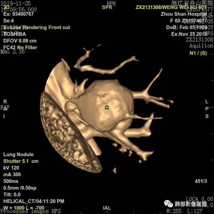 【病例】肺腺癌1例CT影像讨论 【病例】肺腺癌1例CT影像讨论