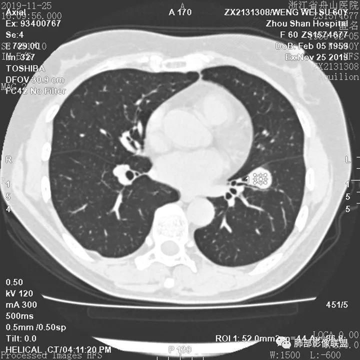 【病例】肺腺癌1例CT影像讨论 【病例】肺腺癌1例CT影像讨论