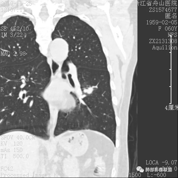【病例】肺腺癌1例CT影像讨论 【病例】肺腺癌1例CT影像讨论