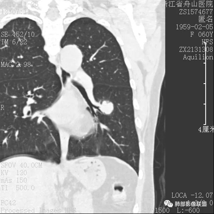 【病例】肺腺癌1例CT影像讨论 【病例】肺腺癌1例CT影像讨论