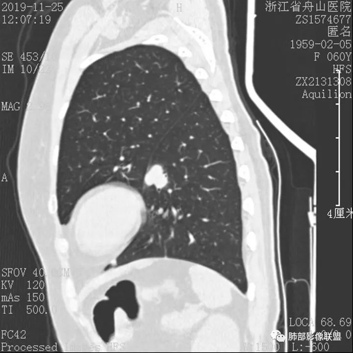 【病例】肺腺癌1例CT影像讨论 【病例】肺腺癌1例CT影像讨论