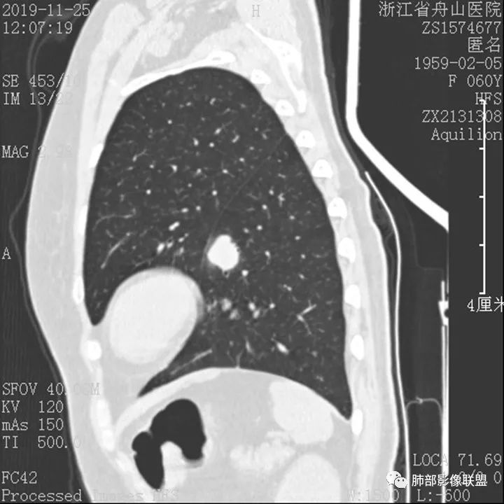 【病例】肺腺癌1例CT影像讨论 【病例】肺腺癌1例CT影像讨论