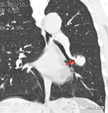 【病例】肺腺癌1例CT影像讨论 【病例】肺腺癌1例CT影像讨论