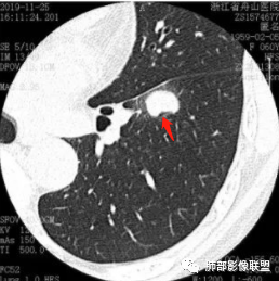 【病例】肺腺癌1例CT影像讨论 【病例】肺腺癌1例CT影像讨论