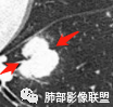 【病例】肺腺癌1例CT影像讨论 【病例】肺腺癌1例CT影像讨论