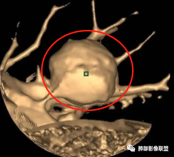 【病例】肺腺癌1例CT影像讨论 【病例】肺腺癌1例CT影像讨论