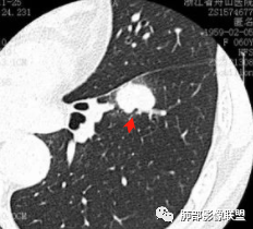 【病例】肺腺癌1例CT影像讨论 【病例】肺腺癌1例CT影像讨论