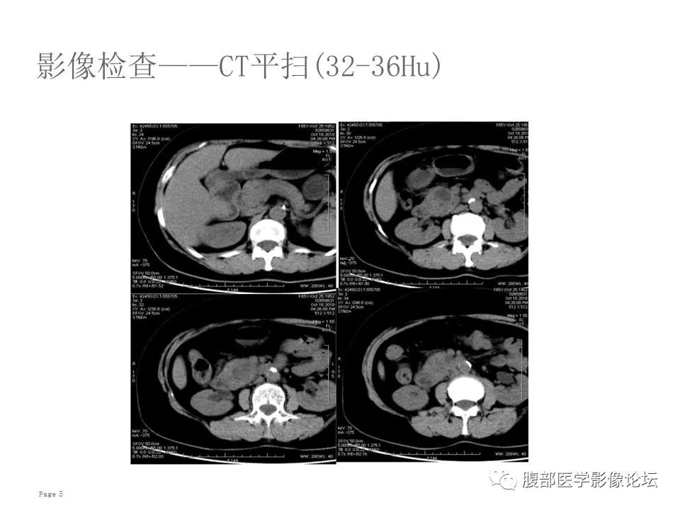 【病例】胰腺导管内乳头状粘液性肿瘤1例CT及MR影像 【病例】胰腺导管内乳头状粘液性肿瘤1例CT及MR影像