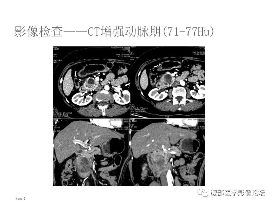 【病例】胰腺导管内乳头状粘液性肿瘤1例CT及MR影像 【病例】胰腺导管内乳头状粘液性肿瘤1例CT及MR影像
