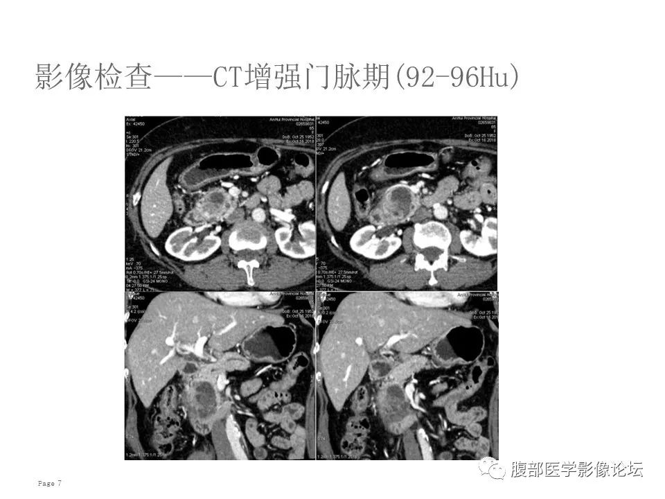 【病例】胰腺导管内乳头状粘液性肿瘤1例CT及MR影像 【病例】胰腺导管内乳头状粘液性肿瘤1例CT及MR影像
