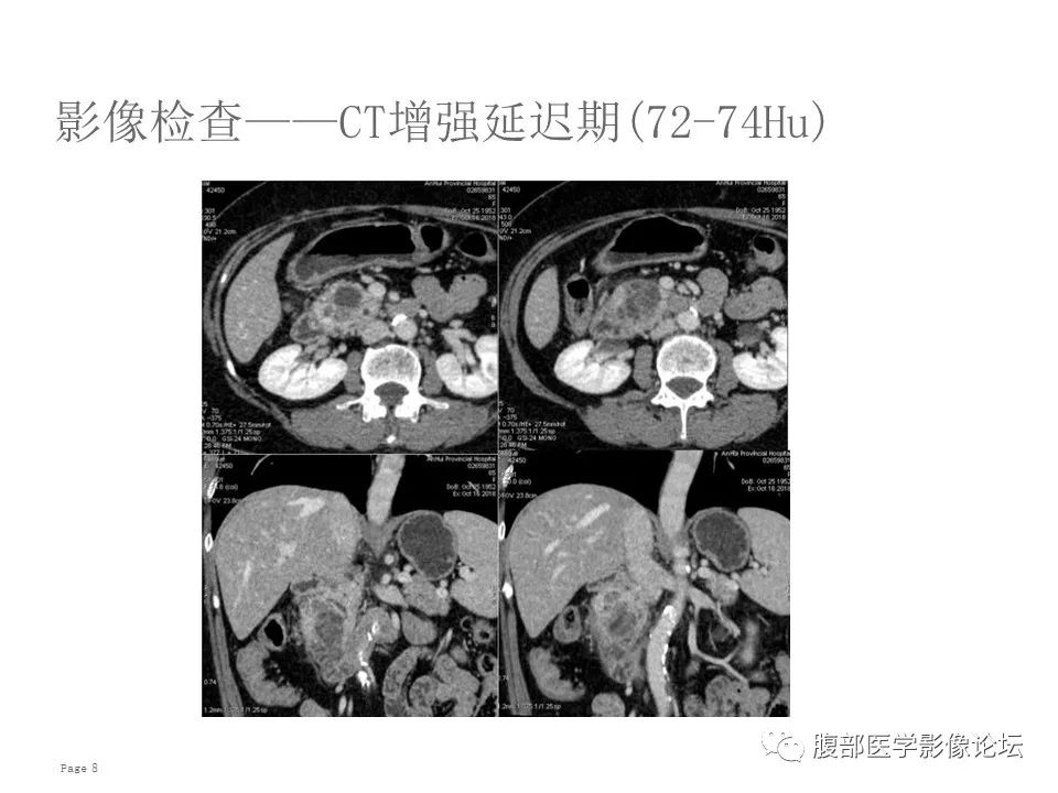 【病例】胰腺导管内乳头状粘液性肿瘤1例CT及MR影像 【病例】胰腺导管内乳头状粘液性肿瘤1例CT及MR影像